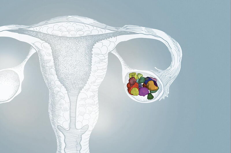 PCO-Syndrom – ein Symptomkomplex PCO-Syndrom – ein Symptomkomplex